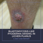 Lichen Planus