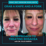 rosacea