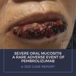 Oral Mucositis