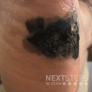 melanoma