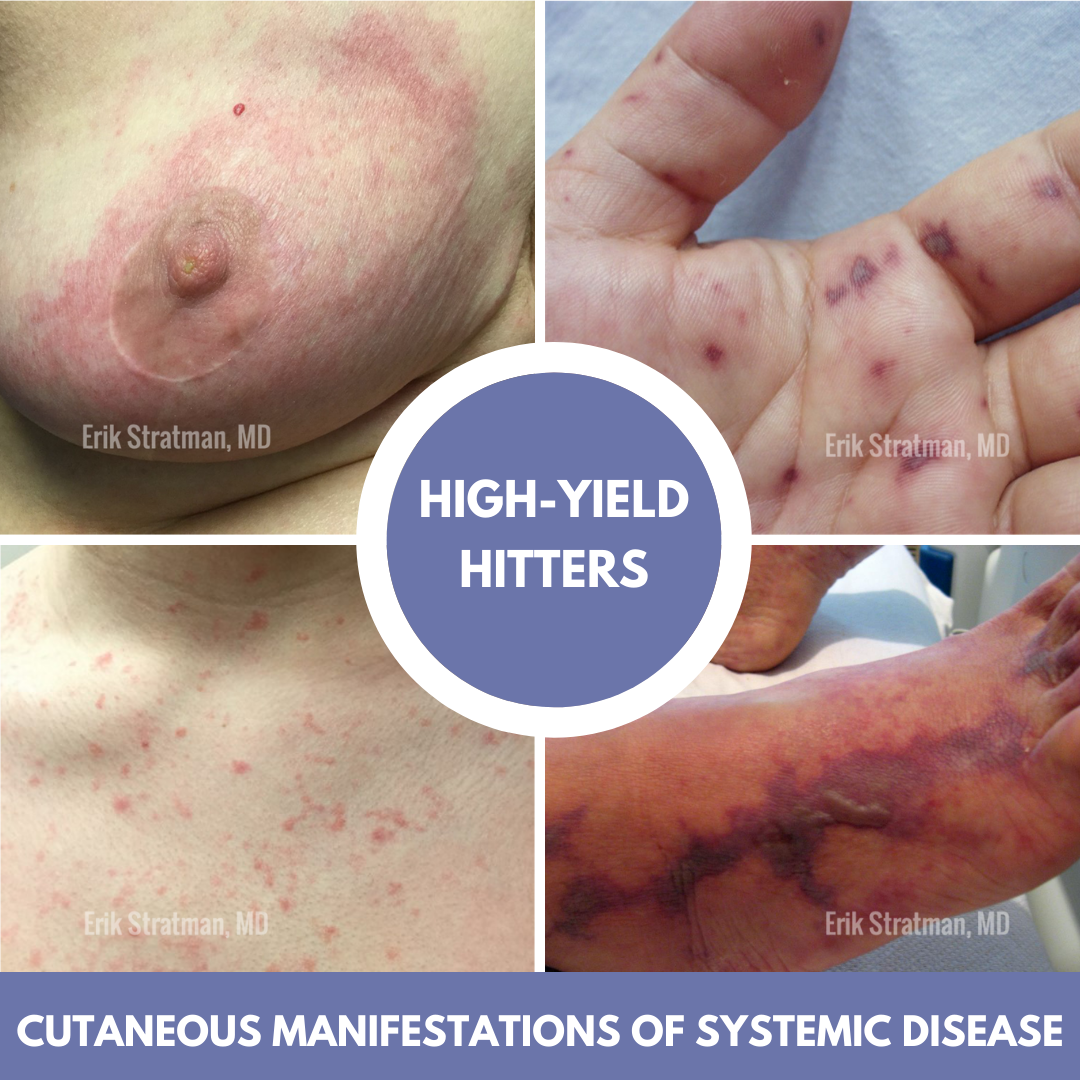 Cutaneous Manifestations of Systemic Disease