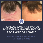 Cannabinoids for Psoriasis