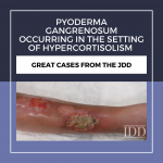 Pyoderma Gangrenosum