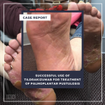 Palmoplantar Pustulosis