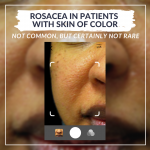 rosacea