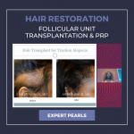 Hair Restoration