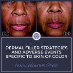 Dermal Filler