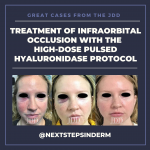 Infraorbital Occlusion