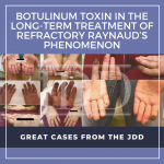 Refractory Raynaud’s Phenomenon