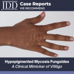 Hypopigmented Mycosis Fungoides (HMF)