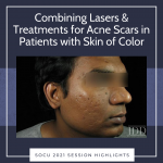 acne scar