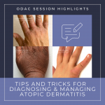 atopic dermatitis