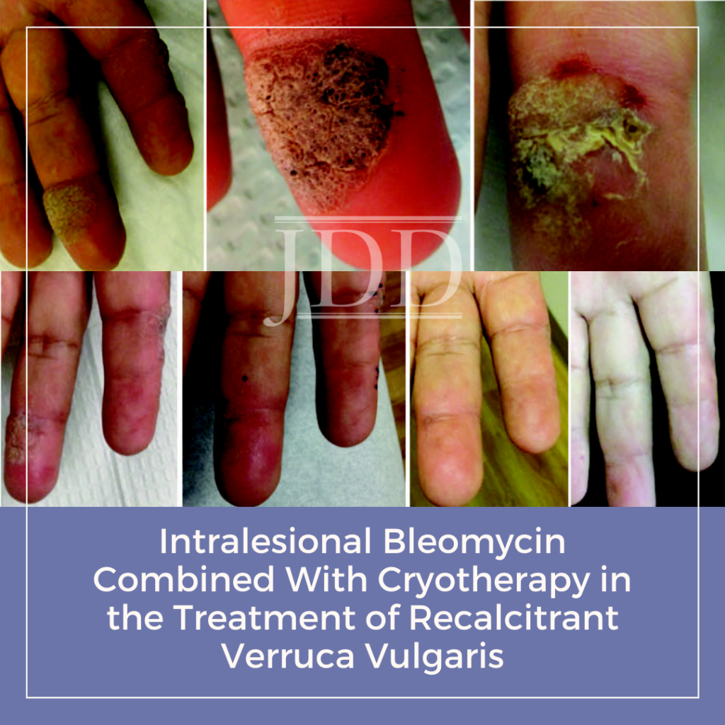 Intralesional Bleomycin Combined With Cryotherapy In The Treatment Of Recalcitrant Verruca