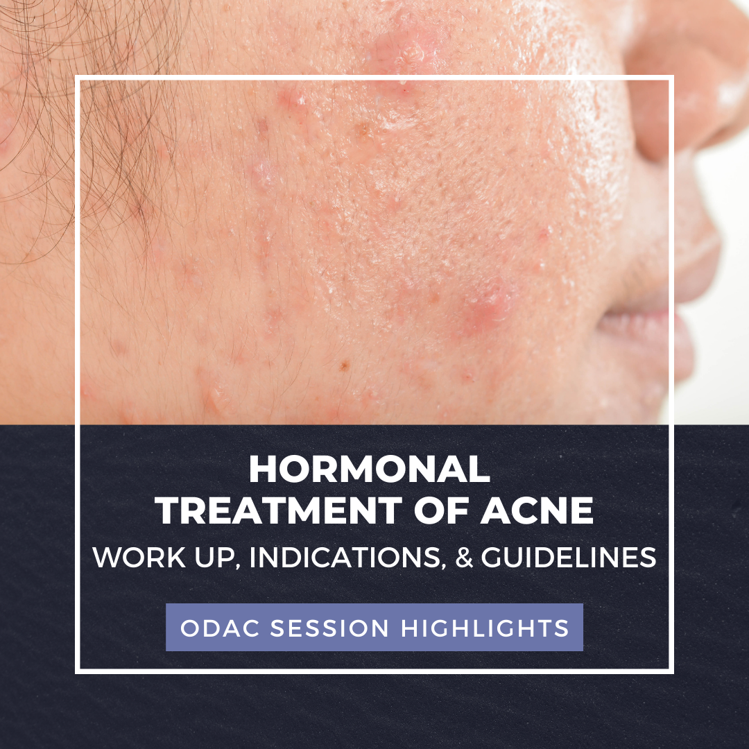 Hormonal treatment of acne