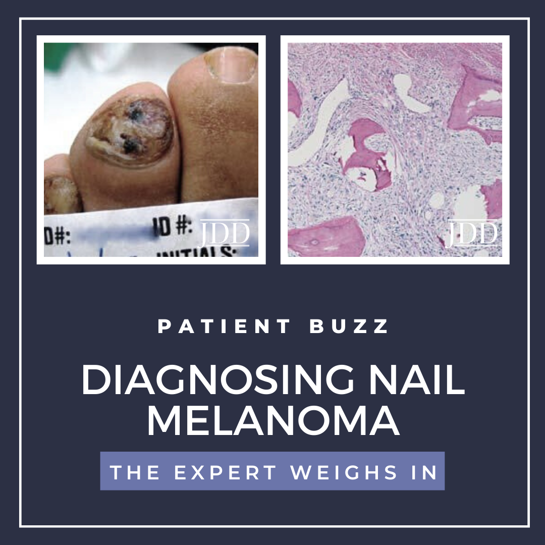 nail melanoma