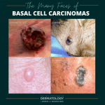 Basal Cell Carcinomas