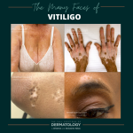 VITILIGO