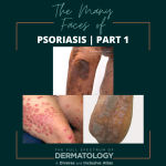 psoriasis