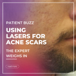 acne scars