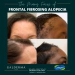 frontal fibrosing alopecia