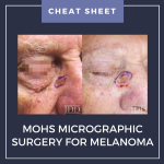 Mohs micrographic surgery