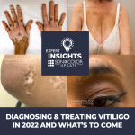 vitiligo