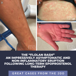 Flolan Rash