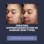 hyperpigmentation