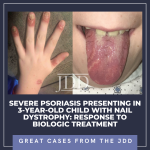 psoriasis