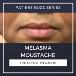melasma