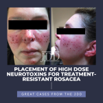 rosacea