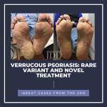 Verrucous Psoriasis