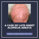 ALOPECIA AREATA