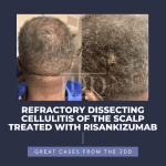 Dissecting Cellulitis