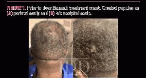 dissecting cellulitis