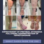 Pretibial Myxedema