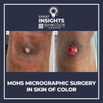Mohs Micrographic Surgery