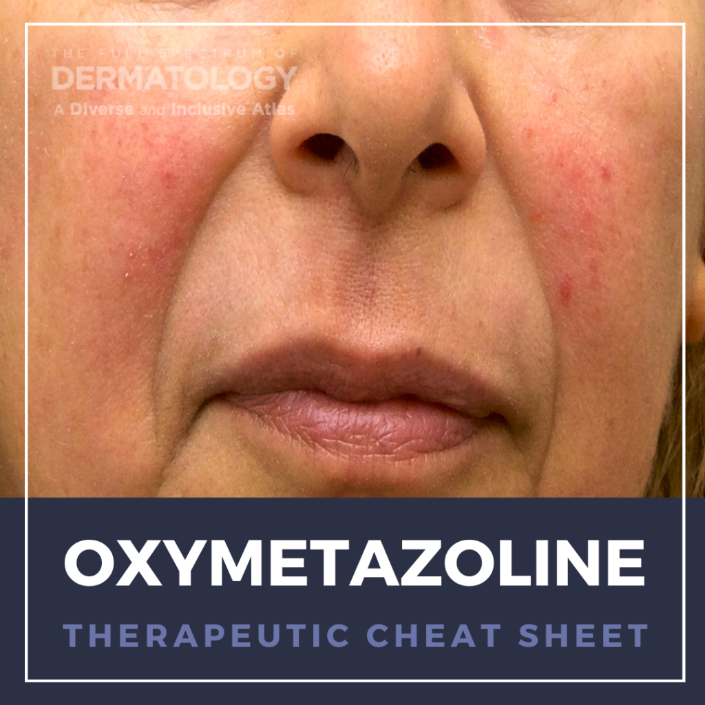 Oxymetazoline Therapeutic Cheat Sheet - Next Steps In Dermatology